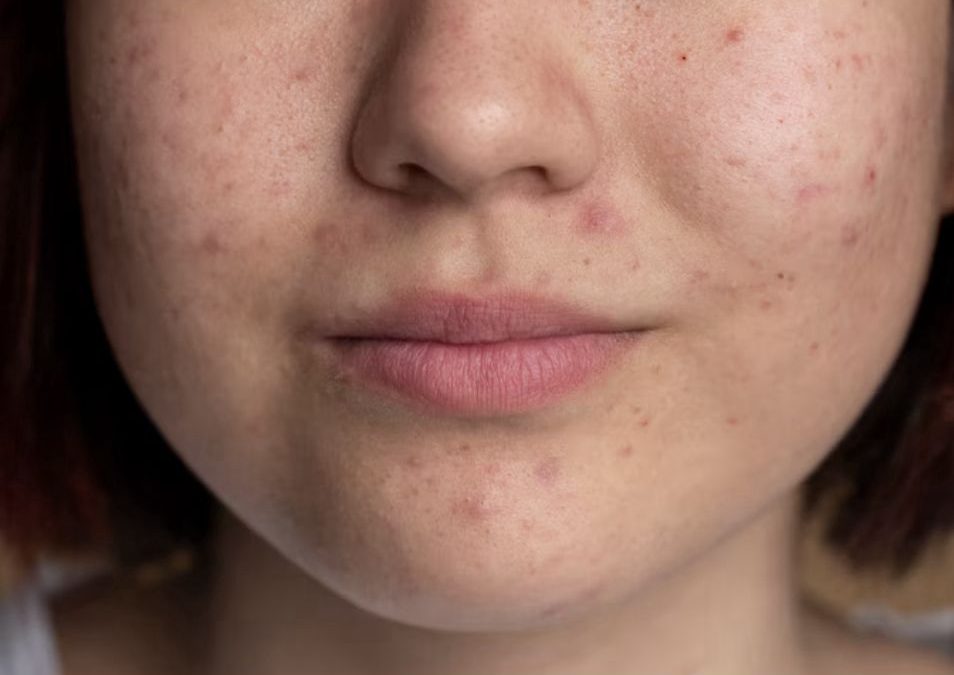 ¿Tienes manchas en la piel? En su día, descubre cómo prevenirlas y tratarlas